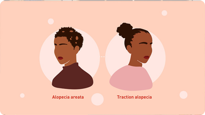 Alopecia Areata in Black Patients Module 1 video thumbnail