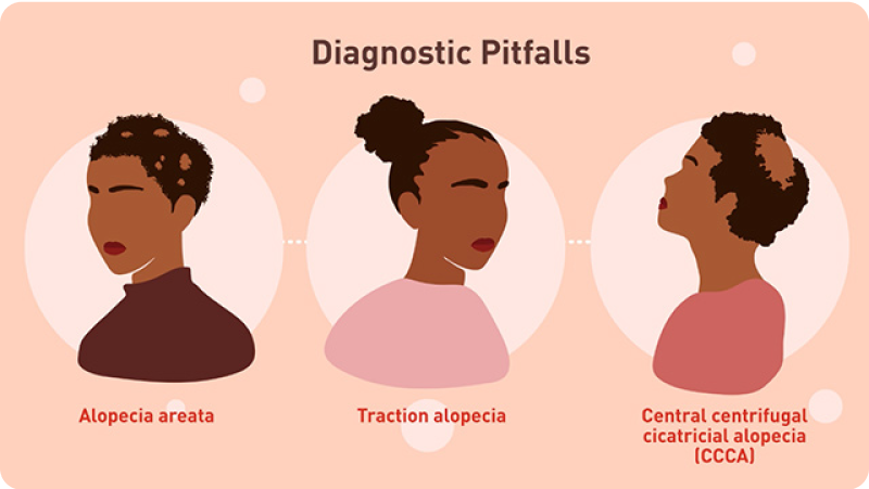 Alopecia Areata in Black Patients Module 3 video thumbnail