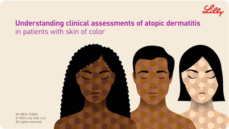 Understanding clinical assessments of atopic dermatitis video thumbnail