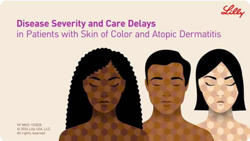 Disease Severity and Care Delays video thumbnail