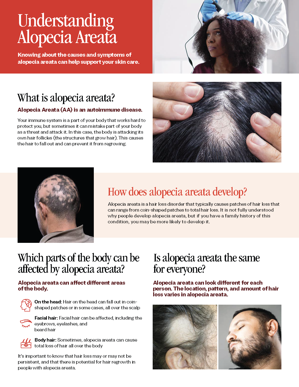 Understanding Alopecia Areata brochure