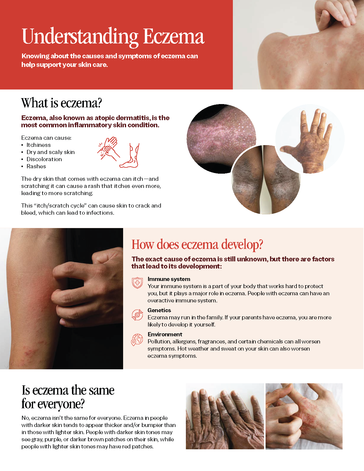 Understanding Eczema brochure
